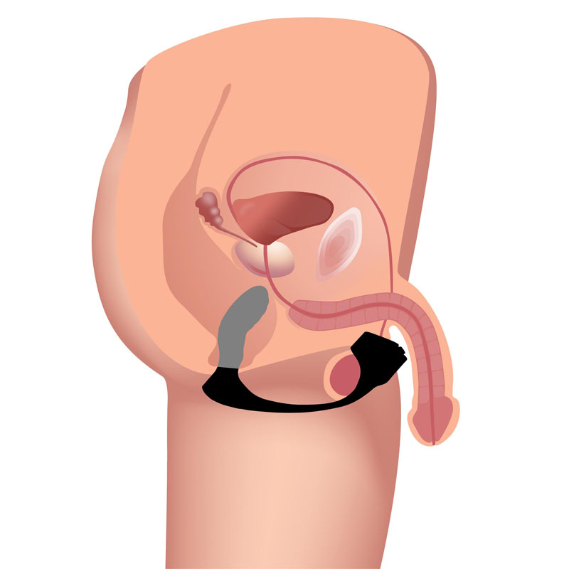 7X Silicone Prostate Plug with Ball Stretcher and Remote - Image 3